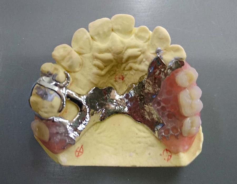 ノンクラスプ金属床