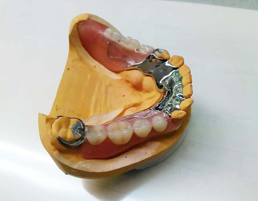 ノンクラスプ金属床