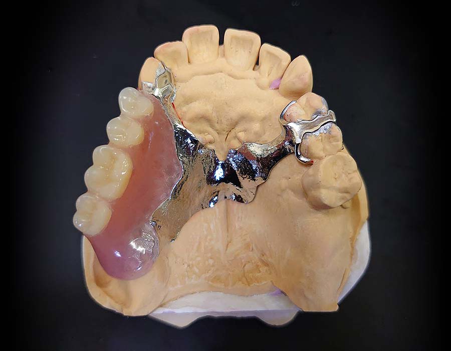 ノンクラスプ金属床