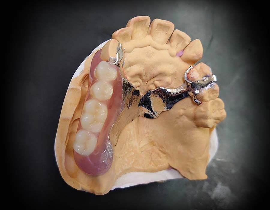 ノンクラスプ金属床