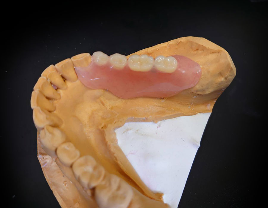 インプラントオーバーデンチャー