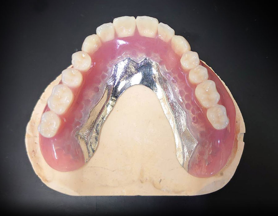 インプラントオーバーデンチャー