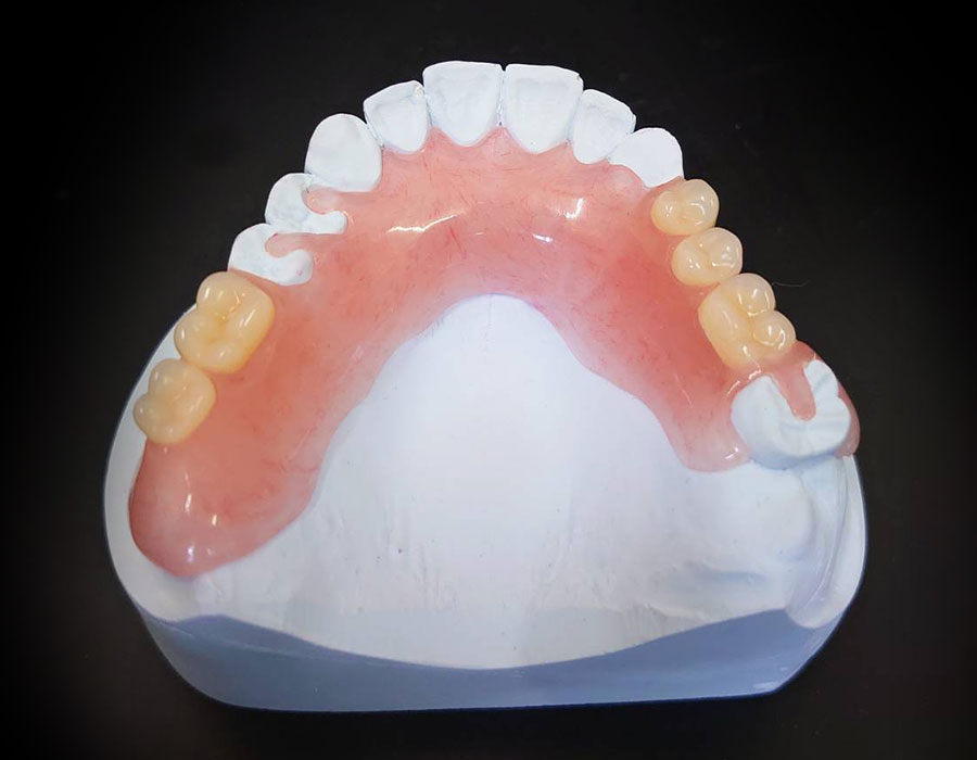 ノンクラスプ