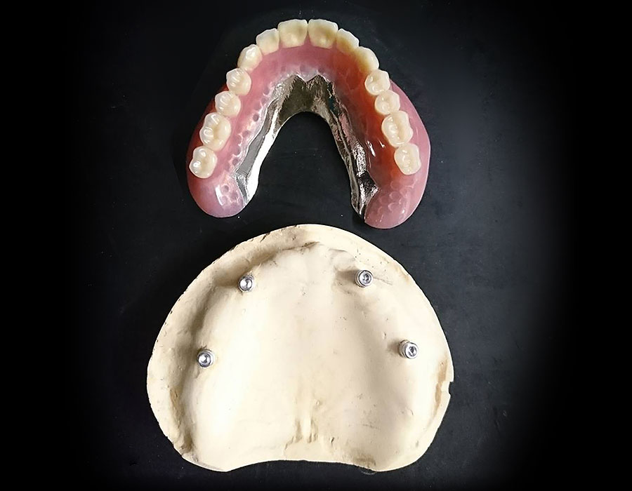 インプラントオーバーデンチャー