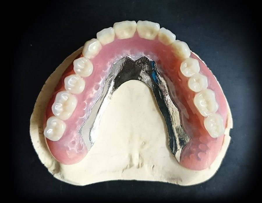 インプラントオーバーデンチャー