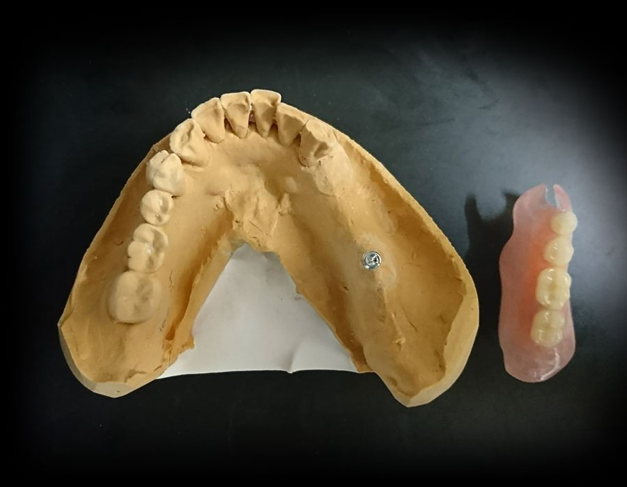 インプラントオーバーデンチャー