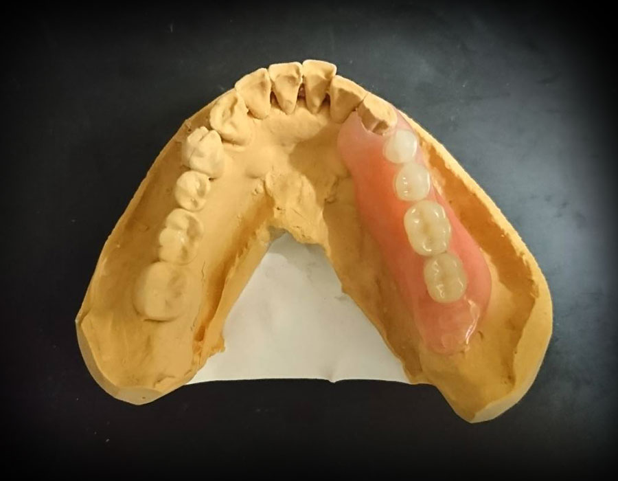 インプラントオーバーデンチャー