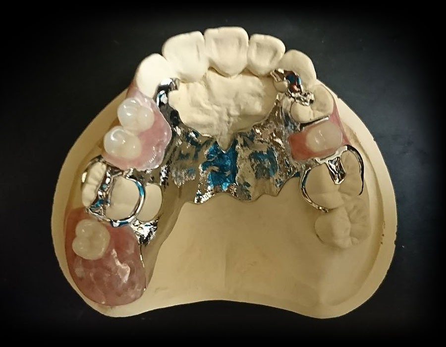 ノンクラスプ金属床