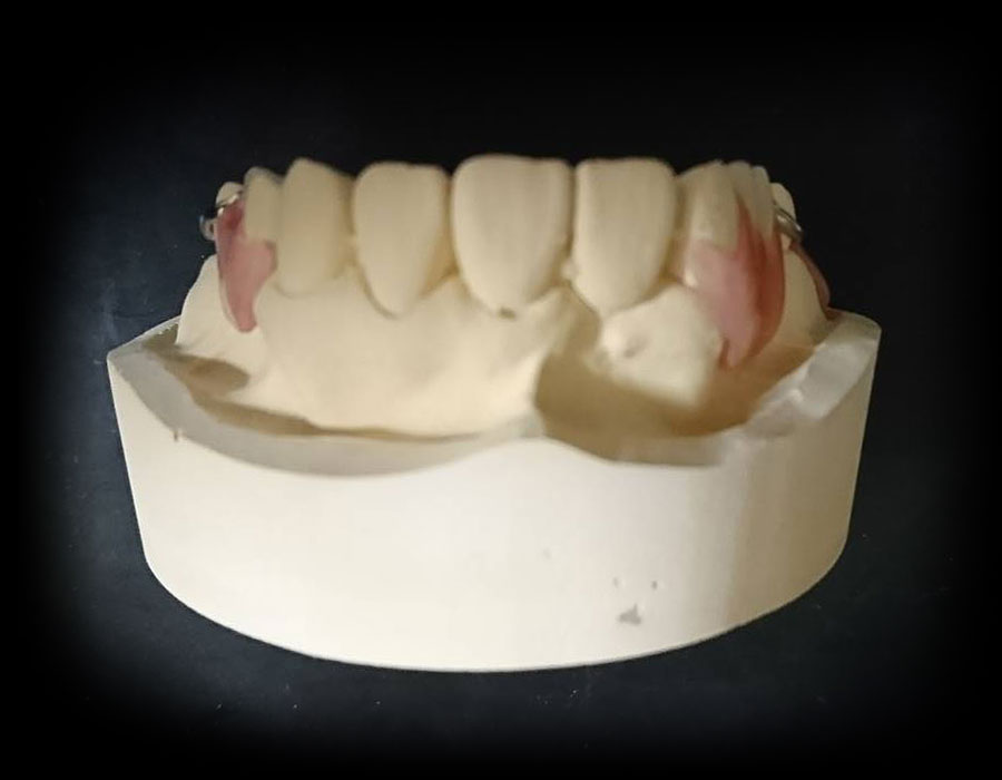 ノンクラスプ金属床